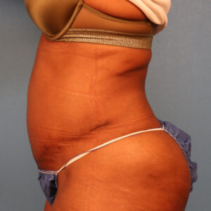 Case--58565 | After Body 2