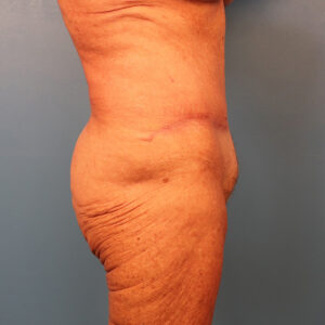 Case--60743 | After Dr. Budny 2
