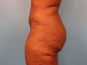 Case--60849 | After Dr. Budny 2