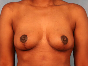 Case--60849 | After Dr. Budny 1