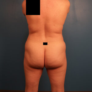 Case--61251 | Before Dr. Budny 1