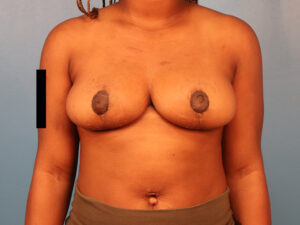 Case--63358 | After Dr. Budny 1
