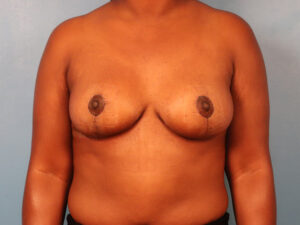 Case--63475 | After Dr. Budny 1