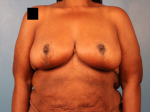 Case--63829 | After Dr. Budny 1
