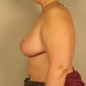 Case--9501 | After Breast 2