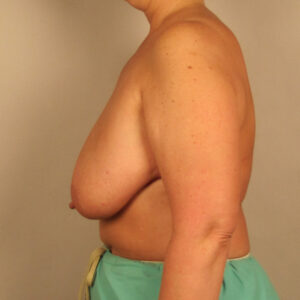 Case--9501 | Before Breast 2