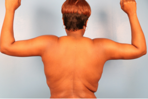 Back view after arm lift surgery (brachioplasty) by Dr. Bentley in Montgomery, AL.