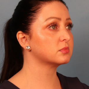 Right three-quarter view after neck contouring surgery by Dr. Bentley in Montgomery, AL.