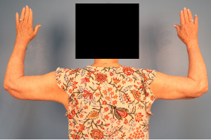 Case--10566 | After Arm Lift (Brachioplasty) 2