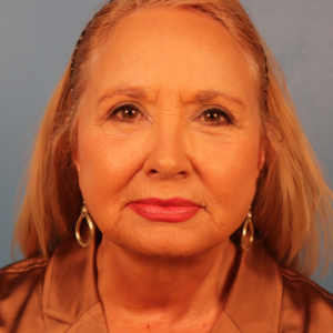 Postoperative frontal view of a female patient after facelift surgery showing improved facial contour, enhanced jawline definition, and a more refreshed appearance at a plastic surgery practice in Montgomery, Alabama.