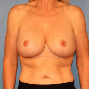 After breast implant exchange by Dr. Budny in Montgomery, Alabama. Front-view post-operative photo showing updated breast implants with improved breast shape, symmetry, and natural-looking results.