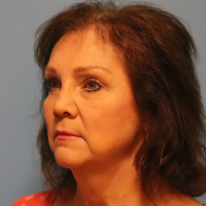 Left three-quarter view after endoscopic brow lift and upper and lower blepharoplasty by Dr. Bentley in Montgomery, AL.