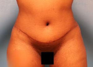After tummy tuck and liposuction showing a flatter abdomen and improved body contour by Dr. Bentley in Montgomery, AL.