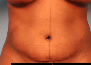 After tummy tuck with liposuction showing a flatter abdomen and more defined waistline by Dr. Bentley in Montgomery, AL.