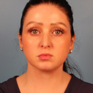 Front view after neck contouring surgery by Dr. Bentley in Montgomery, AL.