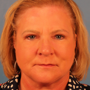 Postoperative frontal view of a patient after upper blepharoplasty showing improved upper eyelid contour and reduced eyelid hooding at a plastic surgery practice in Montgomery, Alabama.