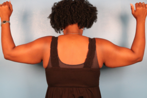Back view before arm lift surgery (brachioplasty) by Dr. Bentley in Montgomery, AL.