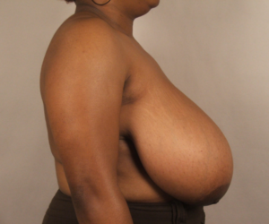 Right profile before breast reduction with mastopexy by Dr. Bentley in Montgomery, AL.