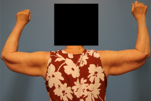 Case--10566 | Before Arm Lift (Brachioplasty) 2