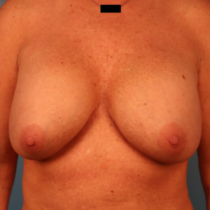 Before breast implant exchange with breast lift by Dr. Budny in Montgomery, Alabama. Front-view pre-operative image showing the patient's breasts before implant replacement and mastopexy surgery.