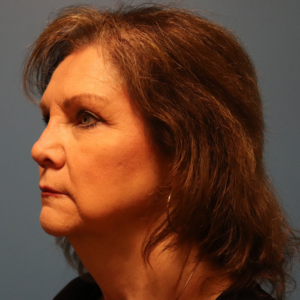 Left three-quarter view before endoscopic brow lift and upper and lower blepharoplasty by Dr. Bentley in Montgomery, AL.