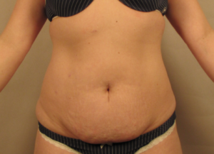 Before tummy tuck surgery showing excess abdominal skin and stretched abdominal tissues before treatment by Dr. Bentley in Montgomery, AL.