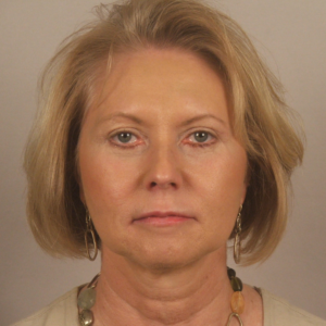 Front view before upper and lower blepharoplasty by Dr. Bentley in Montgomery, AL.