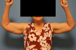 Front view before female arm lift (brachioplasty) surgery by Dr. Bentley in Montgomery, AL.