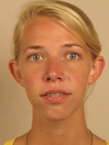 Case--40340 | After Dr. Bentley 1
