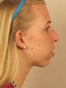 Case--40340 | Before Face 2
