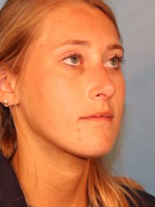 Case--51601 | After Face 2