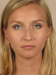 Case--51764 | Before Face 1