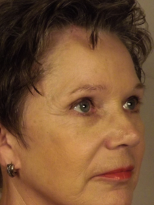 Case--43046 | After Endoscopic Brow Lift 2