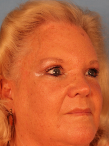 Case--52401 | After Endoscopic Brow Lift 2