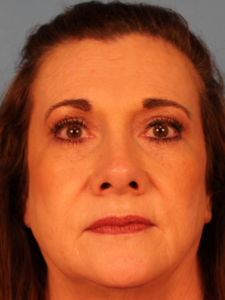Case--38915 | After Endoscopic Brow Lift 1