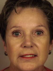 Case--43046 | After Endoscopic Brow Lift 1