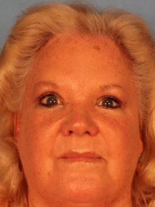 Case--52401 | After Endoscopic Brow Lift 1