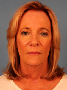 Case--52401 | After Facial Fat Transfer 1