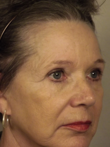 Case--43046 | Before Endoscopic Brow Lift 2