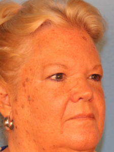 Case--52401 | Before Endoscopic Brow Lift 2