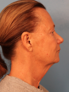 Case--52401 | Before Facial Fat Transfer 2