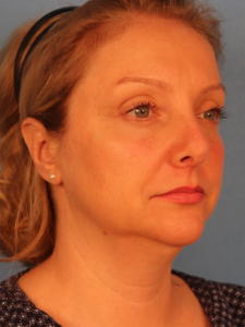 Case--54979 | Before Submental Liposuction 2