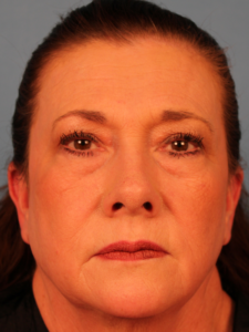Case--38915 | Before Endoscopic Brow Lift 1