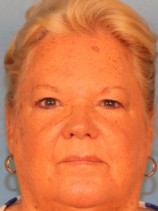 Case--52401 | Before Endoscopic Brow Lift 1