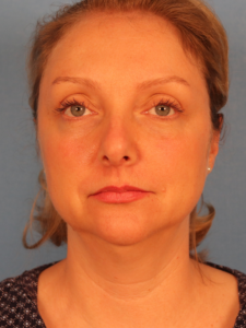 Case--54979 | Before Submental Liposuction 1