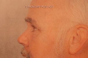 Case--8977 | After Face 2
