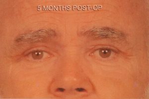 Case--8977 | After Face 1