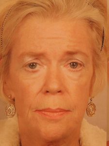Case--4375 | Before Face 1