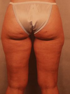 Case--2955 | Before Dr. Budny 1