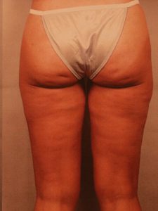Case--2955 | After Dr. Budny 1